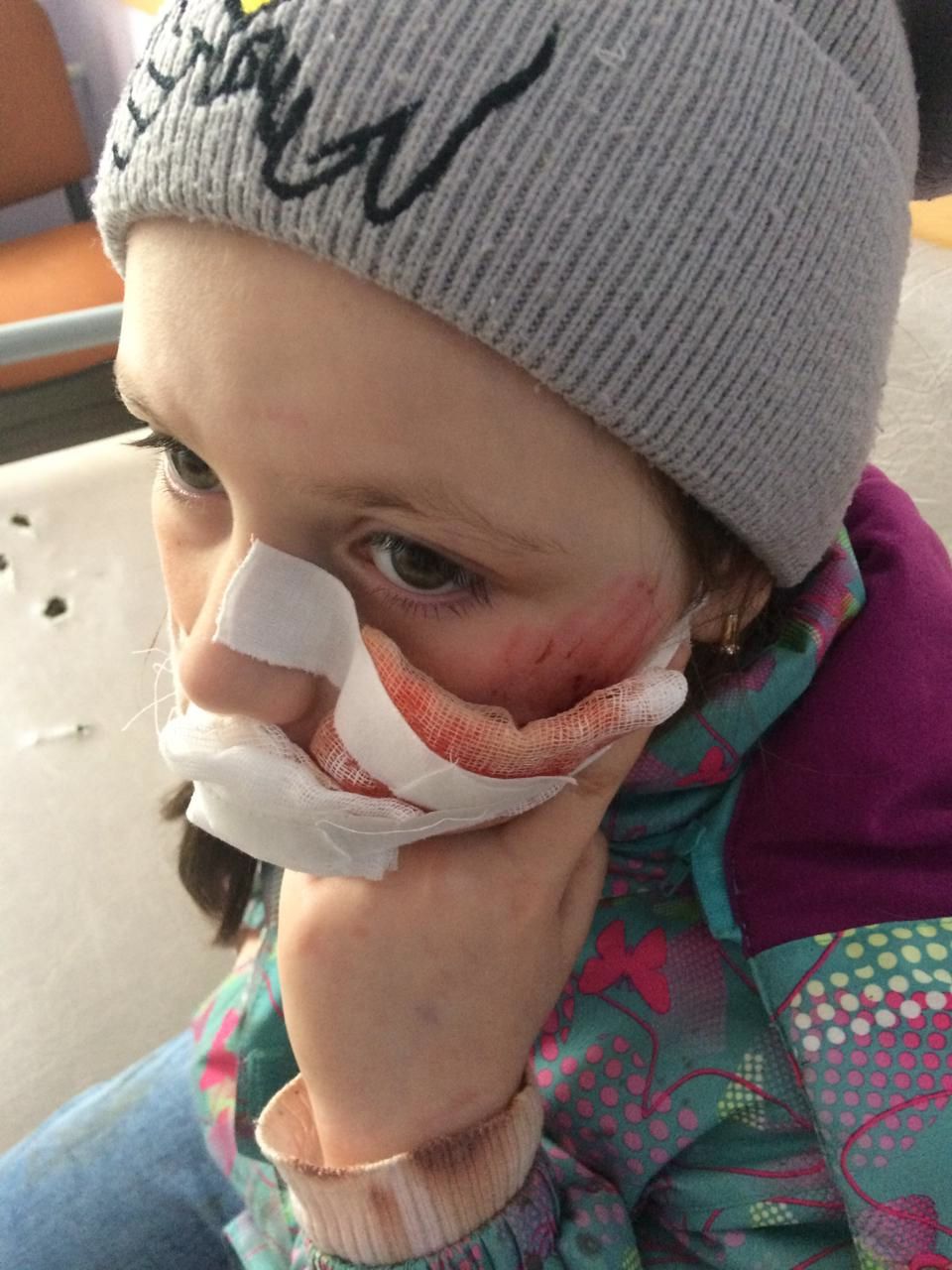 Девочка из Нижнего Одеса, доставленная в Ухту после нападения собаки, будет проходить лечение в УГБ